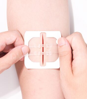 Disposable Emergency wound Closure strips,Pu film strips Can Close The 3cm WoundZip Stitch Wound Closures Device